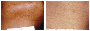Before and After Pictures from Candela Medical
